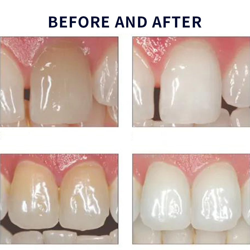Opalescence Whitening 20% PF 2 - Teeth Whitening Before And After recension och pris
