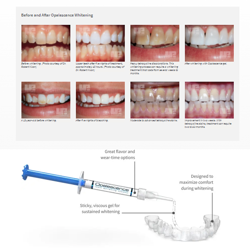 Opalescence Whitening 20% PF 2 - Teeth Whitening Before And After recension och pris
