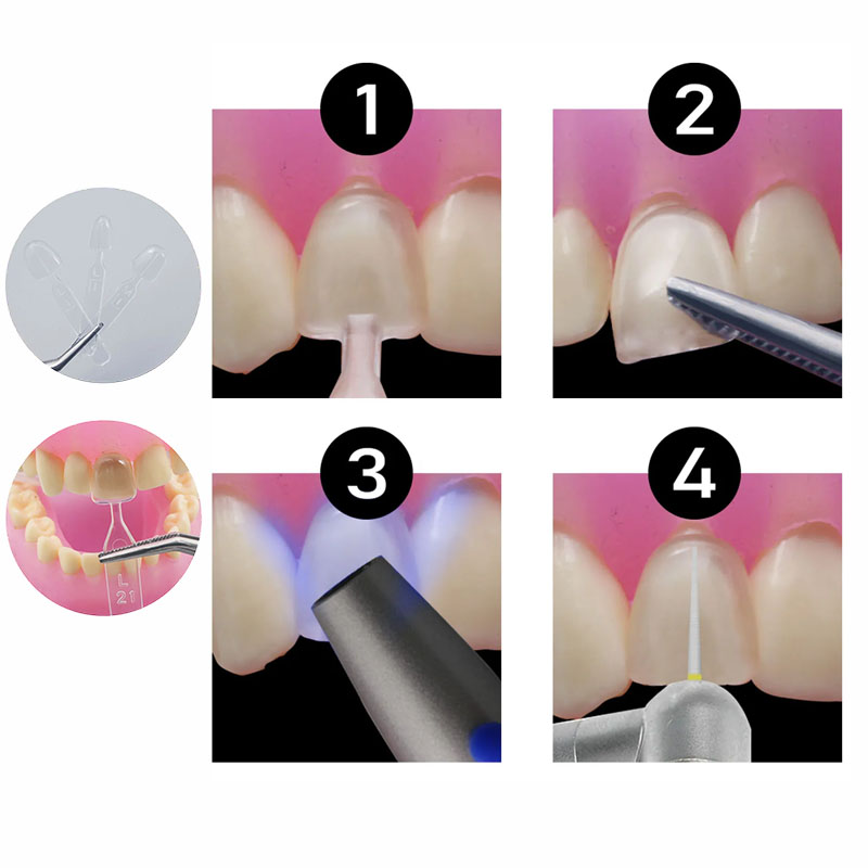 32pcs/Set Composite Resin Mold - Teeth Whitening Moulds recension och pris