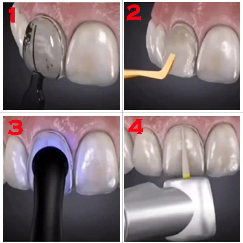 Dentals Mould For Composite Re - Teeth Whitening Moulds recension och pris